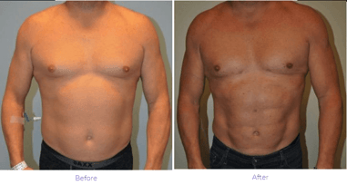 Liposuction men Nashville